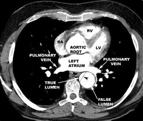 Image result for normal CT aorta | Radiology student, Radiology imaging ...