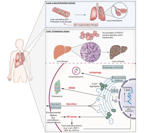 Alpha-1 antitrypsin deficiency: A re-surfacing adult liver disorder - Journal of Hepatology