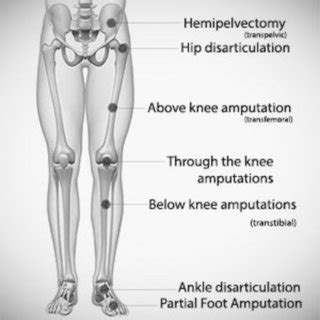 (PDF) Lower Limb Amputations