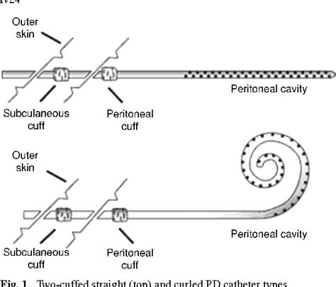 Figure 1 from Peritoneal dialysis catheter placement technique and complications | Semantic Scholar