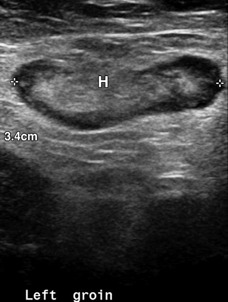 Reactive lymph node in a 51-year-old man with lower extremity... | Download Scientific Diagram