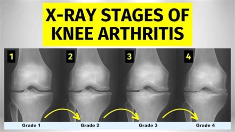 Osteoarthritis Stages Knee