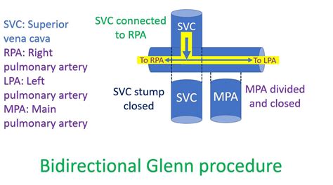 What is a bidirectional Glenn procedure (BDG)? – All About Heart And ...