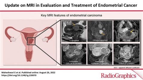 Update on MRI in Evaluation and Treatment of Endometrial Cancer ...