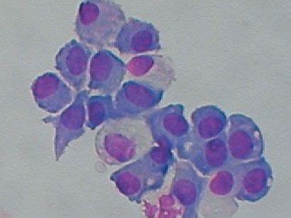 Mesothelial Cells In Ascitic Fluid | Mesothelial Cells Review