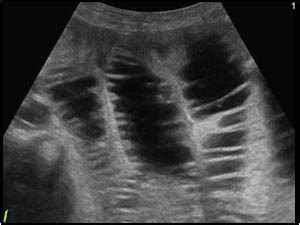 Abdomen and retroperitoneum | 1.6 Gastrointestinal tract : Case 1.6.7 Duodenum and small bowel ...