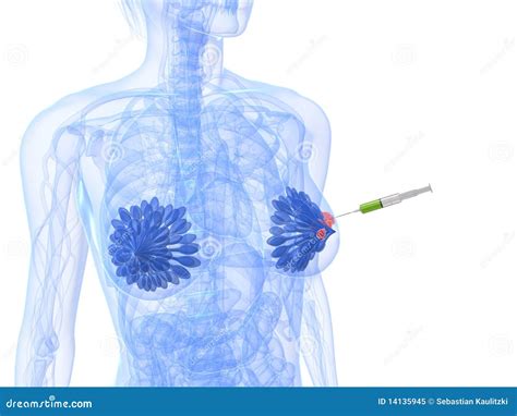 Breast Cancer Injection - Biopsy Royalty Free Stock Photo - Image: 14135945