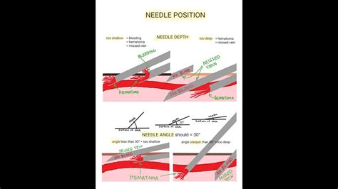 Venipuncture - How to Position a Needle - YouTube