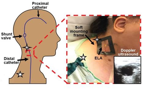 Wireless Skin Sensors Detect Shunt Malfunctio | EurekAlert!