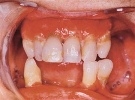 Mucous membrane pemphigoid | Plastic Surgery Key