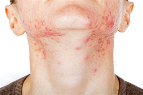 Hormonal Acne: What It Is, Causes, Treatments and Remedies