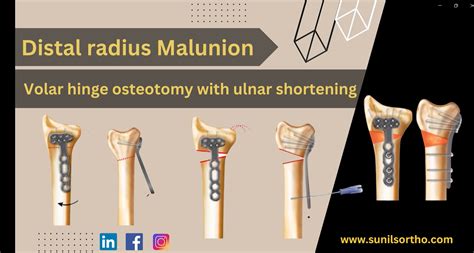 Volar Osteotomy for Distal Radius Malunion — OrthopaedicPrinciples.com
