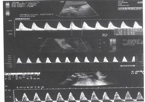 MEDICAL IMAGES: Umbilical artery doppler