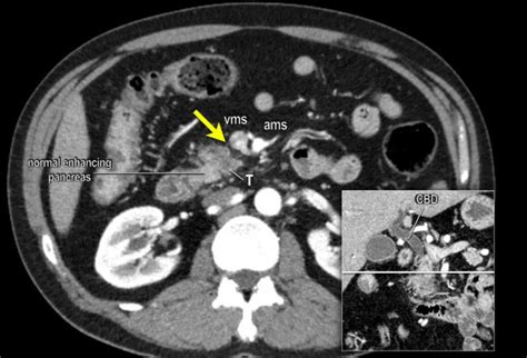 Normal Pancreas Cat Scan