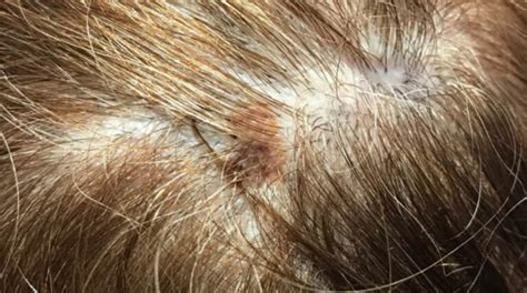 Skin Cancer Bump On Scalp