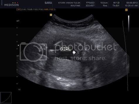 Ultrasound pic-it's a girl, right?? - BabyCenter