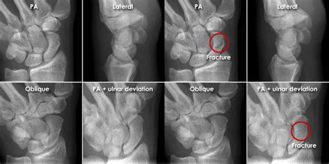 Scaphoid Fracture X Ray Views