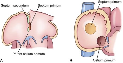 Atrial Septal Defects | Radiology Key