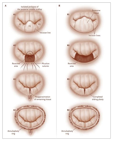 Mitral-Valve Repair for Mitral-Valve Prolapse | NEJM