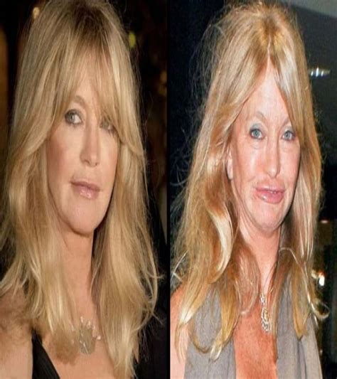 60 Worst Cases Of Celebrity Plastic Surgery Gone Wrong