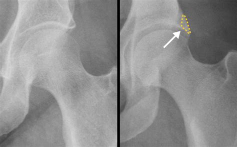 Hip Impingement And Physical Therapy Treatment – [𝗣]𝗥𝗲𝗵𝗮𝗯