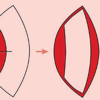 Design of a keystone fasciocutaneous advancement flap. | Download ...