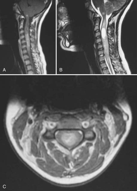 Ependymoma | Neupsy Key