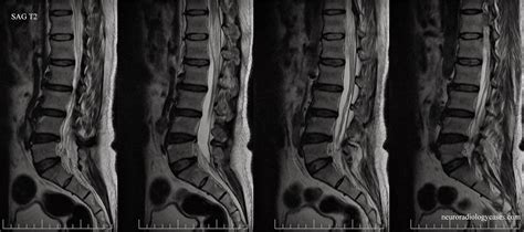 Dr Balaji Anvekar FRCR: Focal Adhesive Arachnoiditis of Spinal Cord