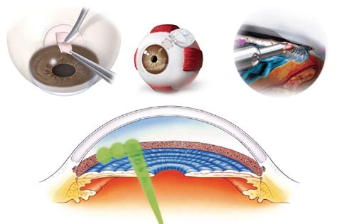 Selective Laser Trabeculoplasty (SLT) After Incisional Glaucoma Surgery | New-Glaucoma ...