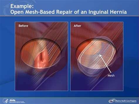 Open Umbilical Hernia Repair Cpt Code 2024 - Binny Cherianne