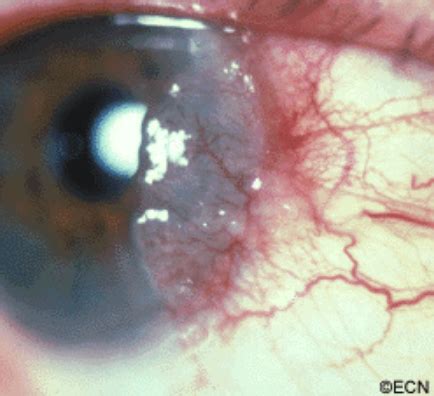 Squamous Carcinoma and Intraepithelial Neoplasia of the Conjunctiva » New York Eye Cancer Center