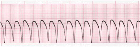 Ventricular Rhythms