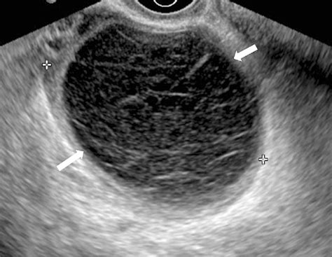 Corpus Luteum Cyst Ultrasound