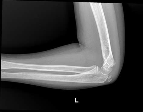 OrthoDx: Medial Epicondyle Fractures - Clinical Advisor