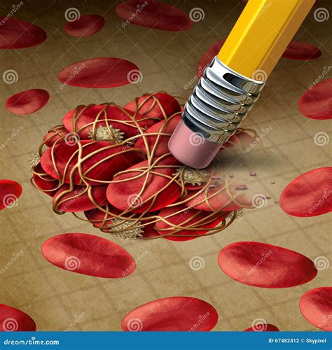 Blood Clot Treatment stock illustration. Illustration of disease - 67482412