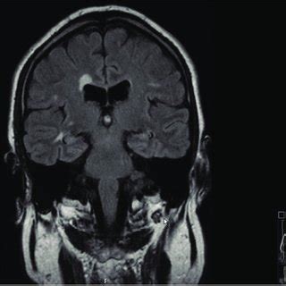 MRI FLAIR coronal section: Periventricular white matter lesion and... | Download Scientific Diagram