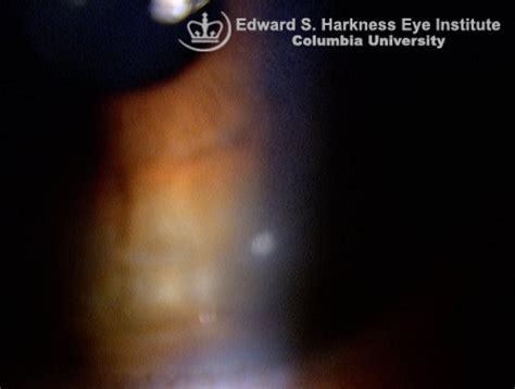 Peripheral Corneal Infiltrate | Vagelos College of Physicians and Surgeons