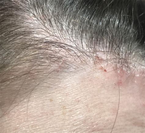 Is this dry scalp, psoriasis, or something else? This is a photo of the edge of my scalp. It has ...