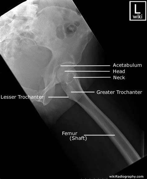 FEMUR LATERAL PROXIMAL in 2021 | Medical radiography, Diagnostic imaging, Radiology student