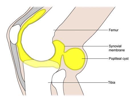 Popliteal cyst - Symptoms, diagnosis and treatment | BMJ Best Practice