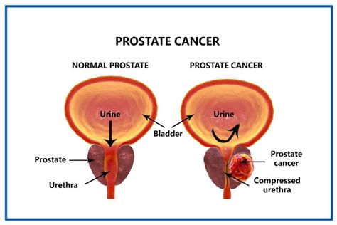 Prostate Cancer: Symptoms, Causes, Diagnosis & Treatment