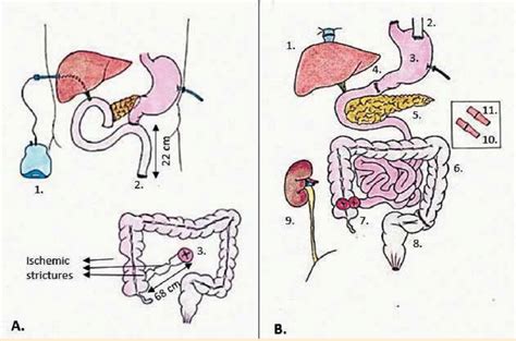 Ileostomy And Mucous Fistula