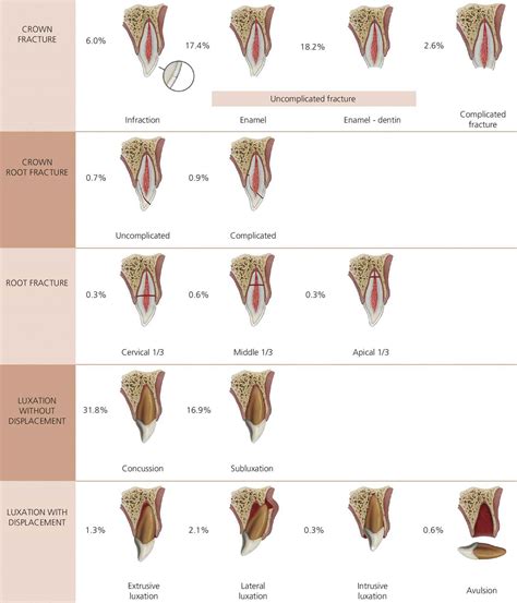 18: Traumatic Dental Injuries | Pocket Dentistry