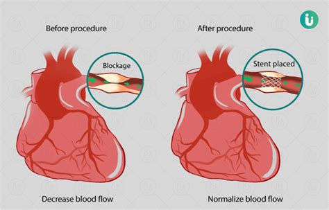 Angioplasty: Procedure, Purpose, Results, Cost, Price