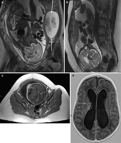 Clinical Indications to MRI in Pregnancy | Radiology Key