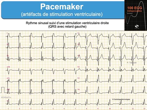 Pacemaker 3. Signes ECG : e-cardiogram