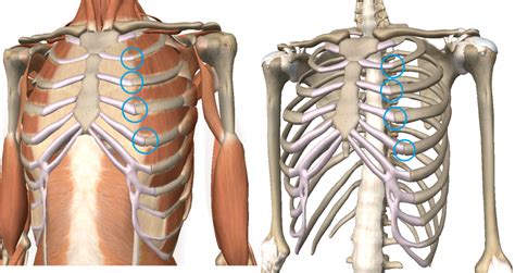 Rib Pain as Costochondritis « Innova Pain Clinic