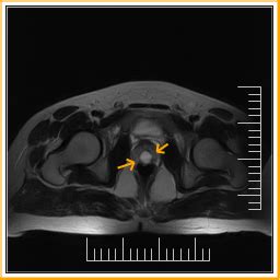 Prostatic utricle cyst-MRI - Sumer's Radiology Blog