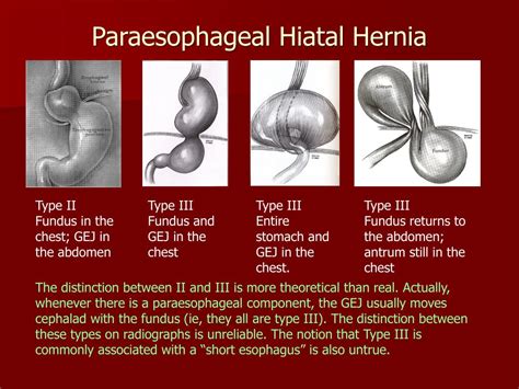 PPT - Laparoscopic Paraesophageal Hiatal Hernia Repair and Fundoplication PowerPoint ...