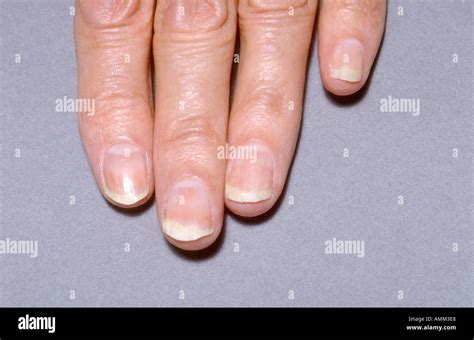 Chronic fungal infection fingernails Stock Photo - Alamy